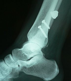 ボルトが埋め込まれた状態の、私の右足 07.1.13 ボルトが埋め込まれた状態の、私の右足 07.1.13の画像