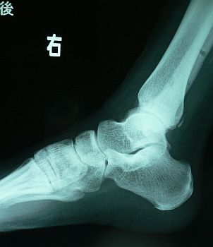 ボルトが抜かれた、手術後の私の右足　　07.1.13の画像